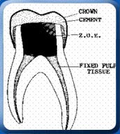 dental_images-root-canal