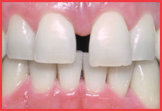 Large Gap in Front Teeth-Sunnyvale Dental Care