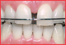 Removable Orthodontic Appliance-Sunnyvale Dental Care