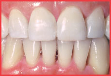 Final Orthodontic Result-Sunnyvale Dental Care