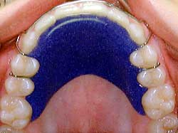 Orthodontic Retainer