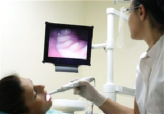 Intraoral Camera-Sunnyvale Dental Clinic
