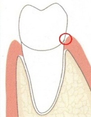 The problem of loose teeth begins in the gingival sulcus